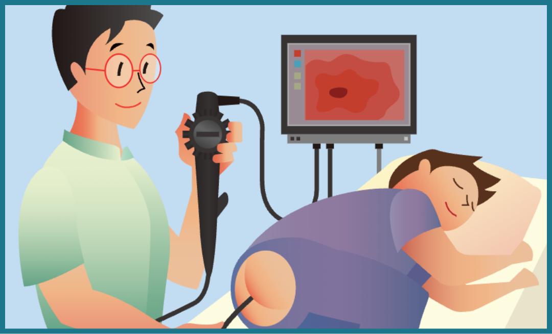 大腸がん検査のイメージ画像