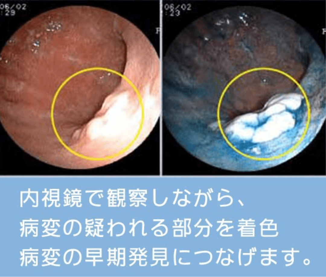 胃がん検査のイメージ画像